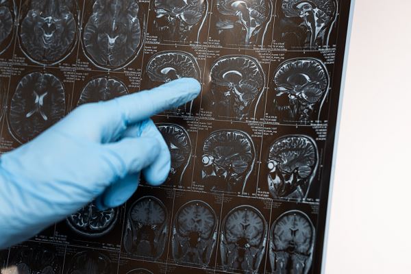 COVID может влиять на мозг, как Альцгеймер